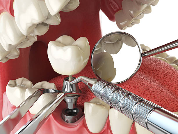 Best Emergency Treatment for Dental Infections or Abscesses in Elkader, IA